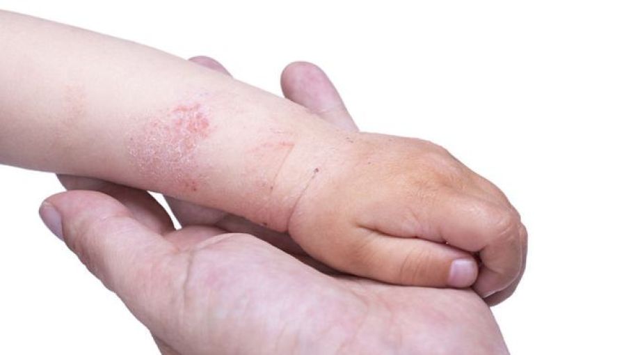 Dermatitis Atopik Pada Anak