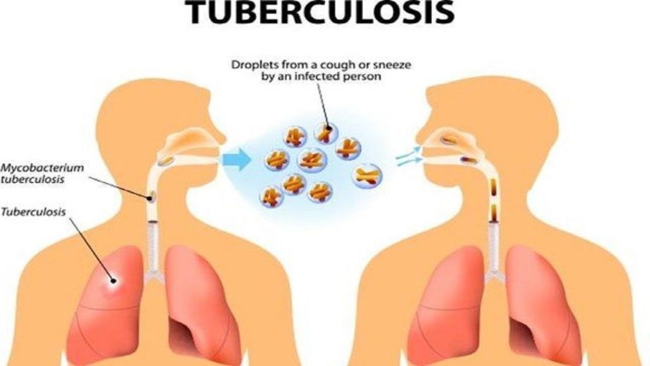 Patuhi Minum Obat Tuberkulosis