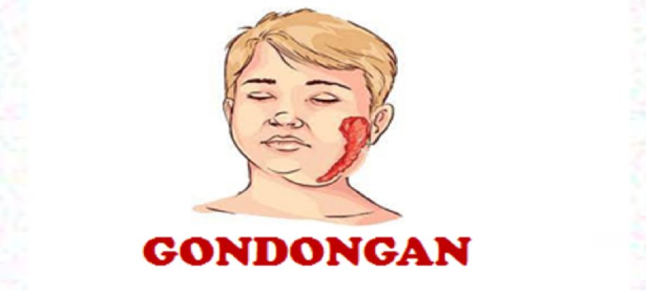 Gondongan (Parotis)